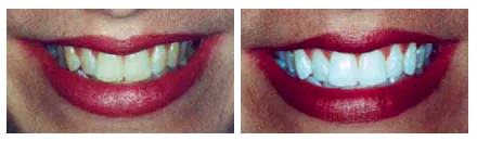 Swedesboro Teeth Whitening
